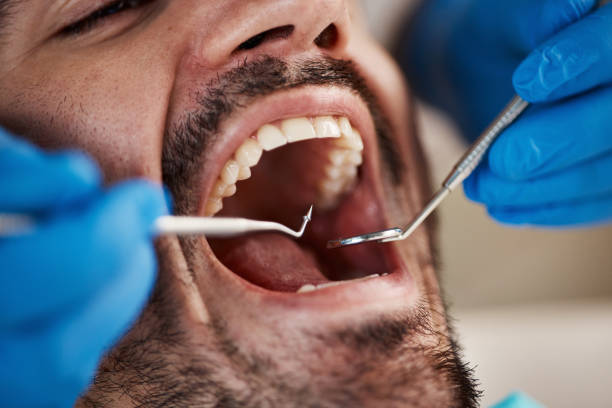Best Emergency Dentist for Lost Fillings or Crowns in Southside, AL